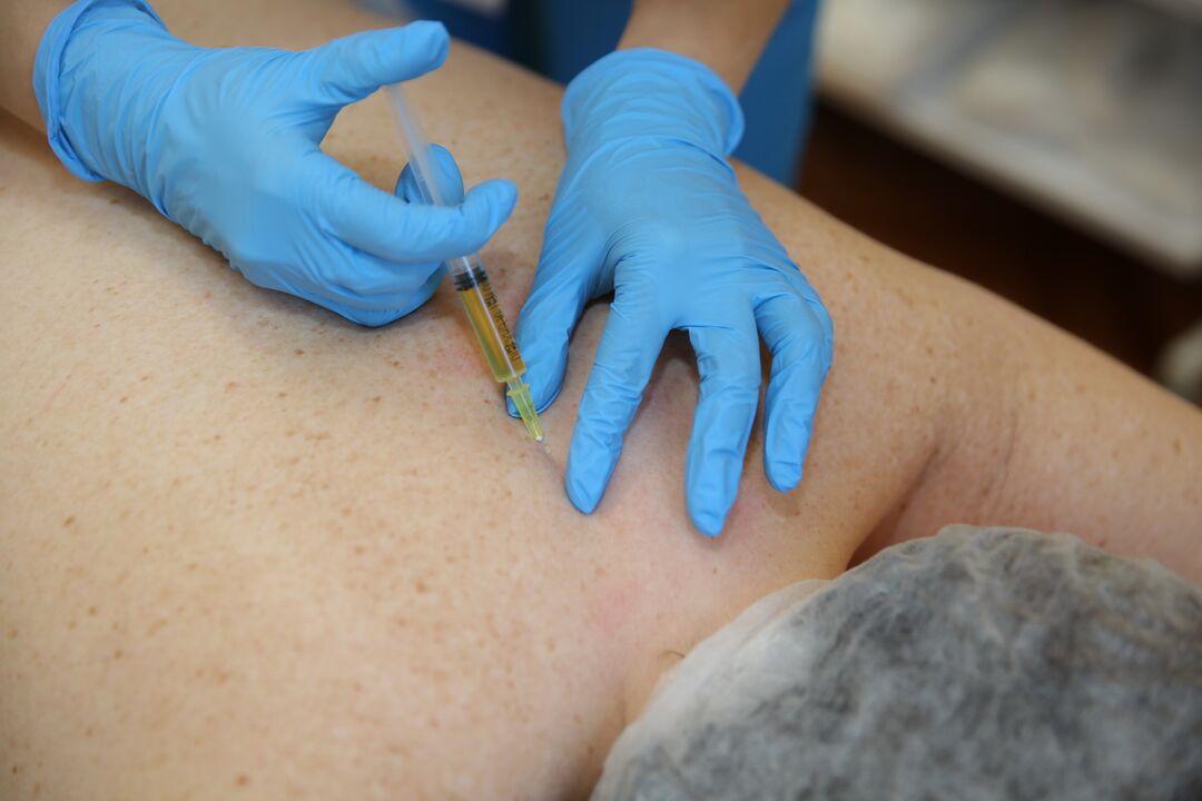 kondroprotektorite süstid seljale